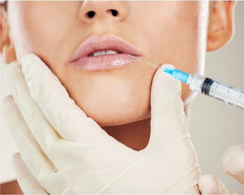 HOW LONG DOES IT TAKE FOR LIP FILLERS TO SETTLE?