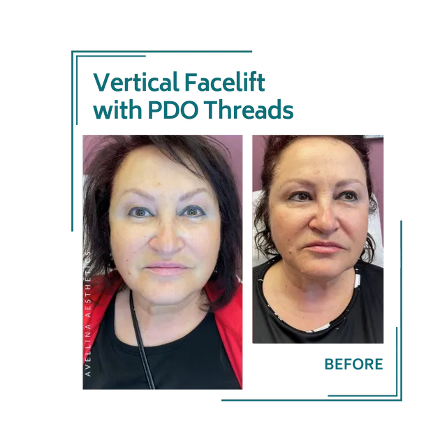 PDO threads_17avellinaaesthetics