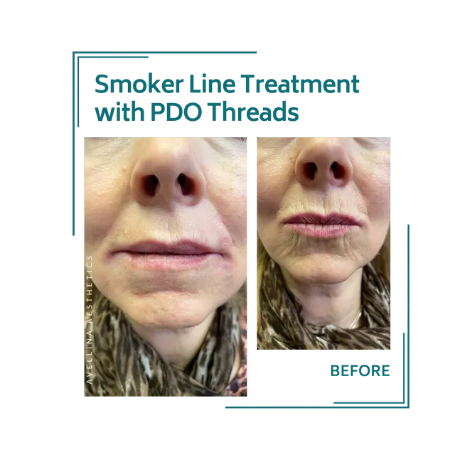 PDO threads_21avellinaaesthetics