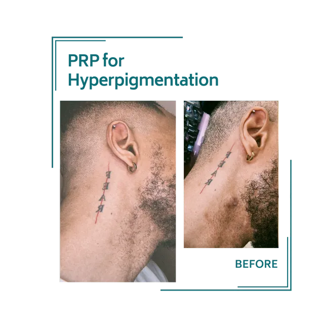 PRP_29avellinaaesthetics