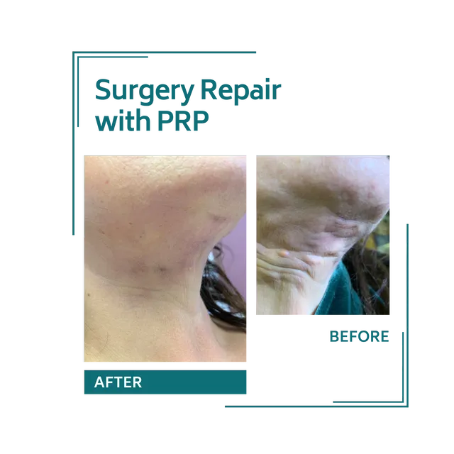 PRP_30avellinaaesthetics