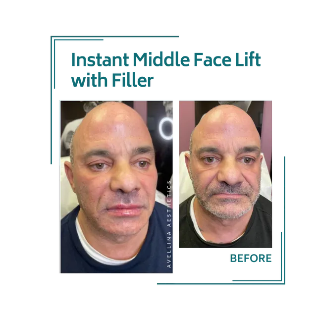 fillers_1avellinaaesthetics
