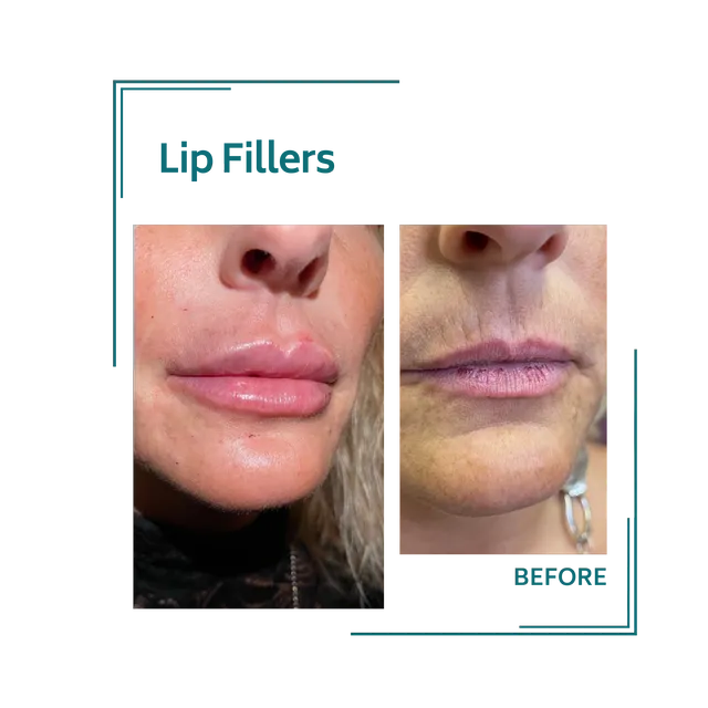 fillers_4avellinaaesthetics