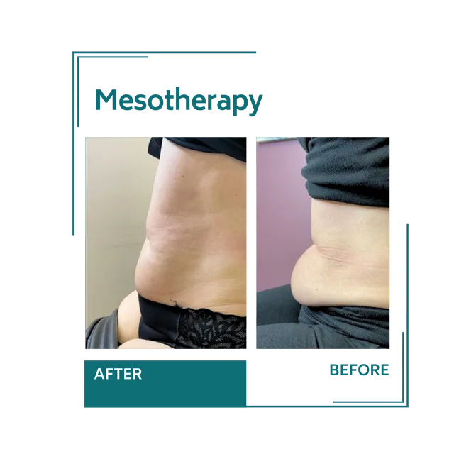 mesotherapy_12avellinaaesthetics