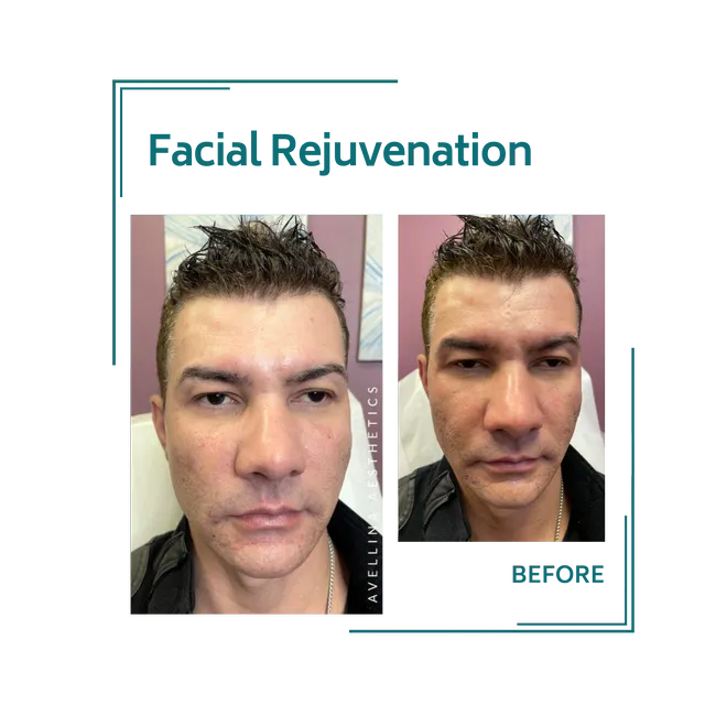 redjuvenation_24avellinaaesthetics