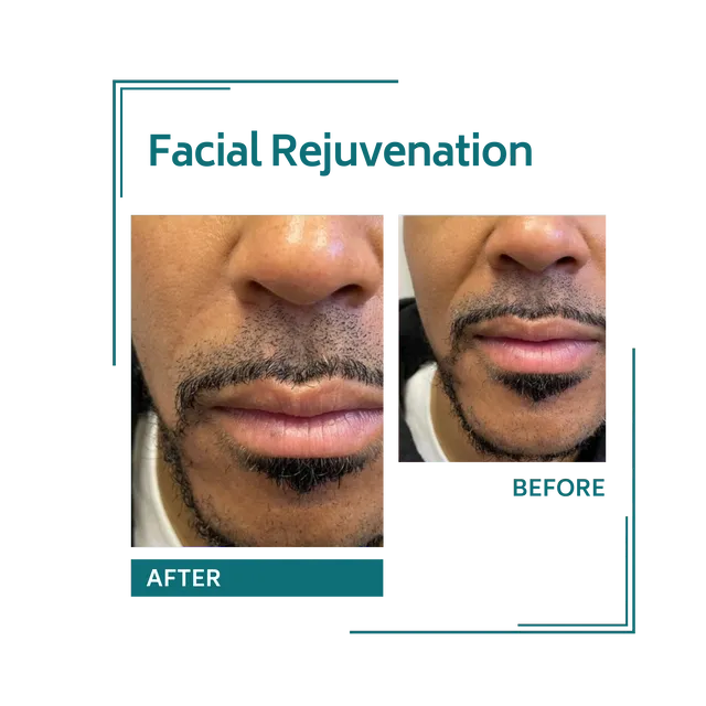 redjuvenation_26avellinaaesthetics