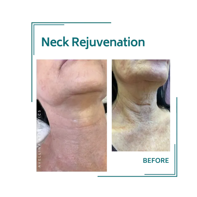 redjuvenation_27avellinaaesthetics