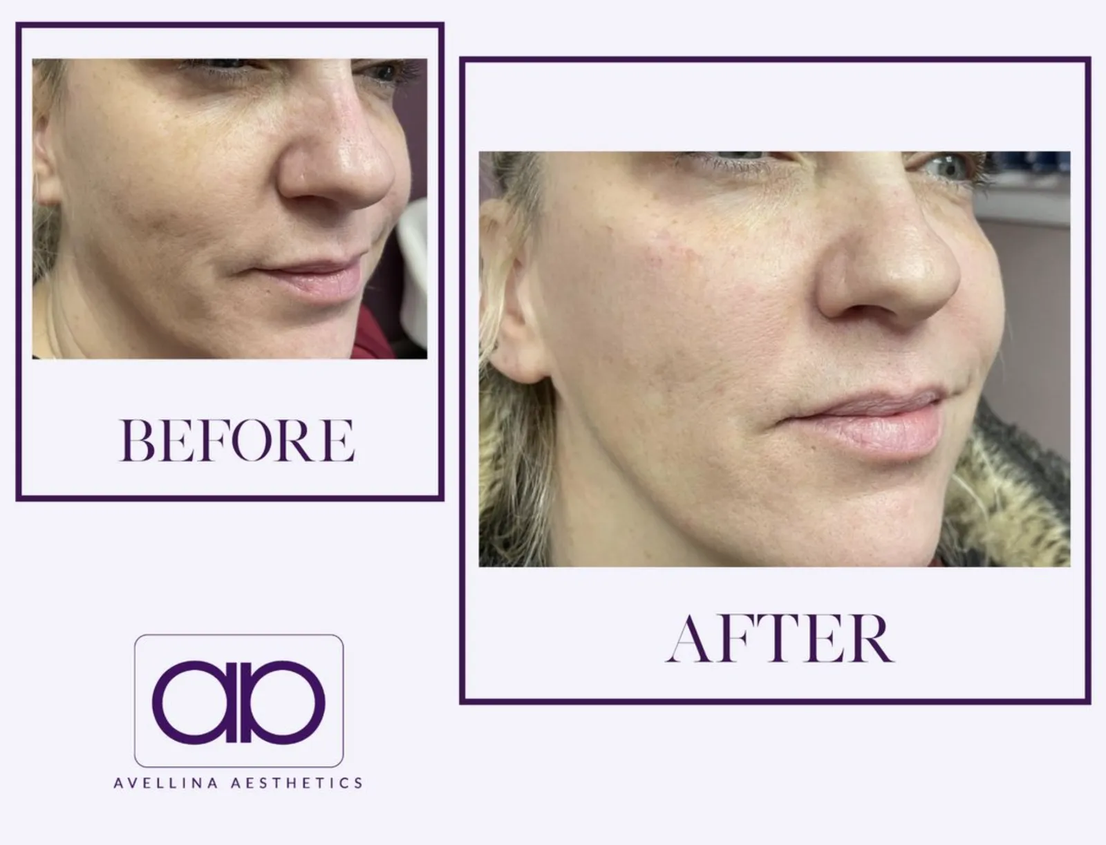 How to Properly Prepare Your Skin Before Aesthetic Treatments