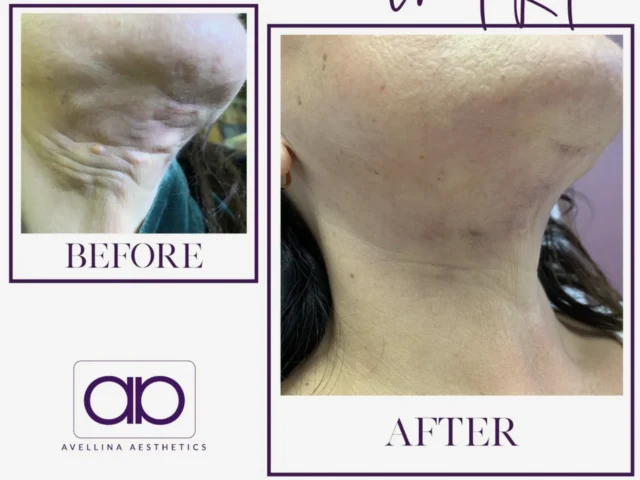 Microneedling vs PRP: Understanding the Key Differences and Benefits