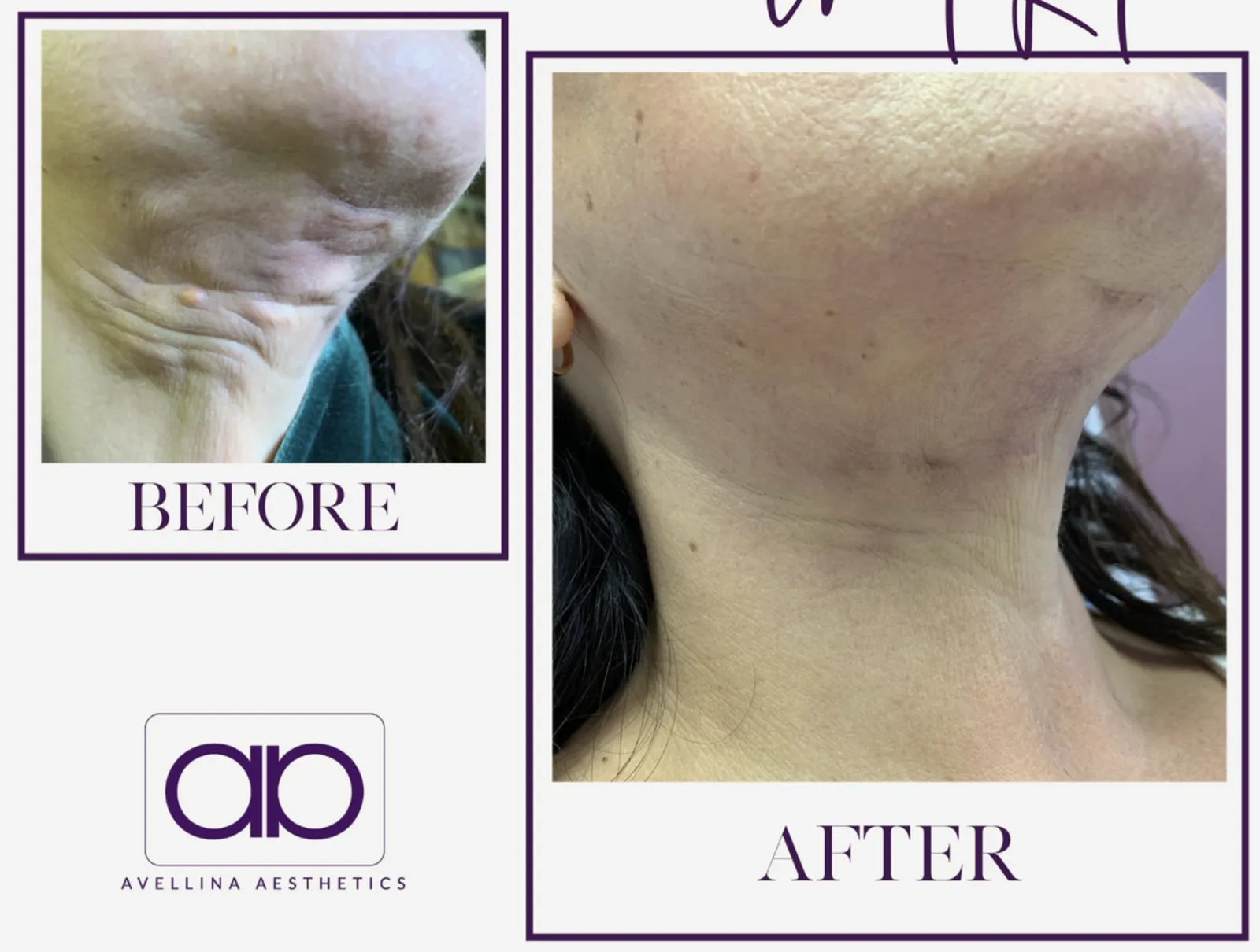 Microneedling vs PRP